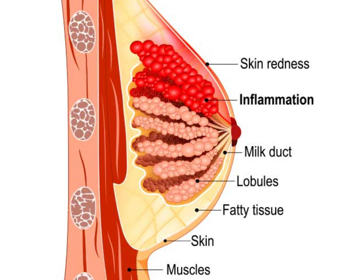 Mastitis: Updated Guidance